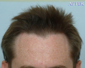 before-image