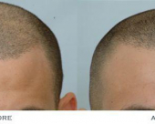 before-image