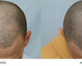 before-image