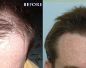 before-image