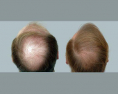 before-image