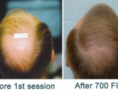 before-image
