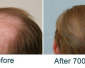 before-image