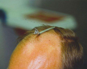 before-image